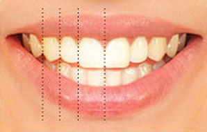Relative tooth dimension and proportion