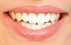 Interincisal Angles