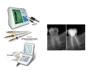 Endodontics (root canal)